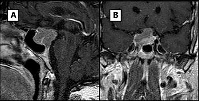 A Silent Corticotroph Pituitary Carcinoma: Lessons From an Exceptional Case Report